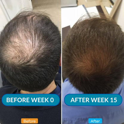 Infusion Hair Regrowth Kit