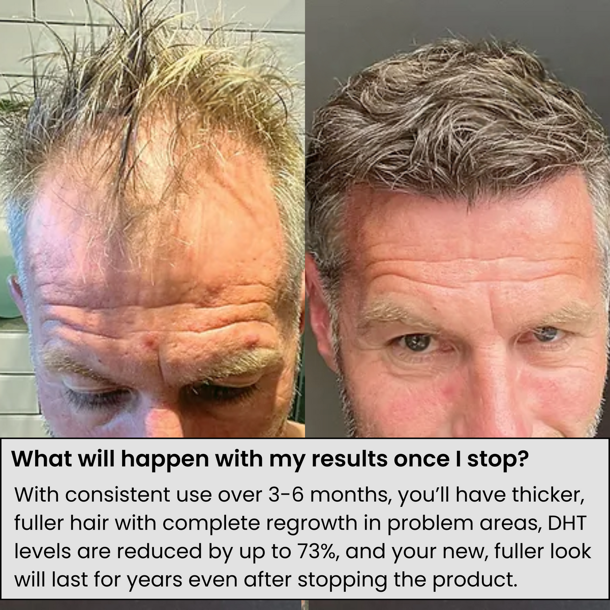 AlphaInfuse Hair Regrowth System
