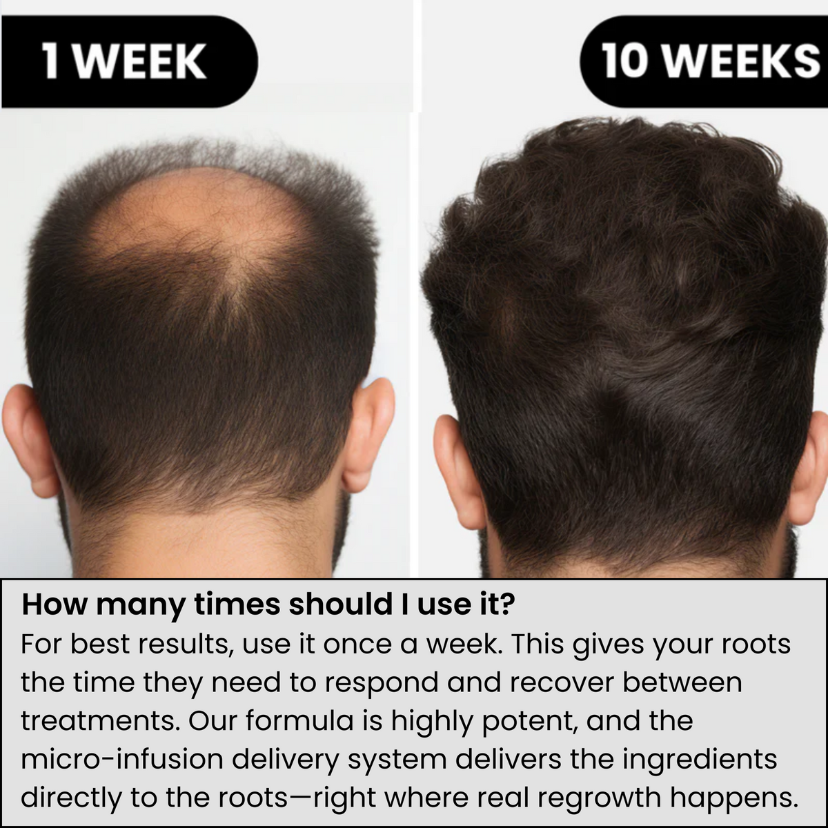 AlphaInfuse Hair Regrowth System