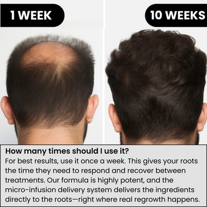 AlphaInfuse Hair Regrowth System